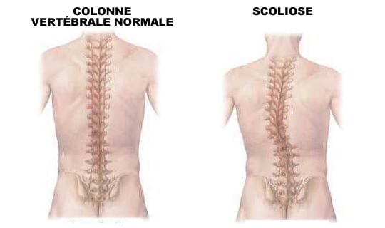 colone vertébrale normale vs scoliose